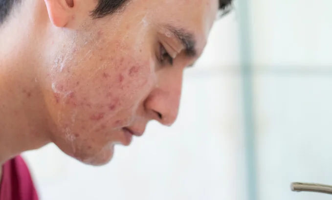 does does tadalafil cause acne